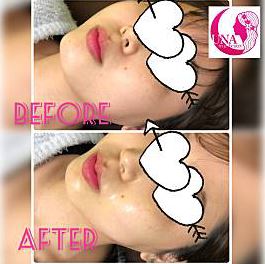 UNAハイフのビフォーアフター