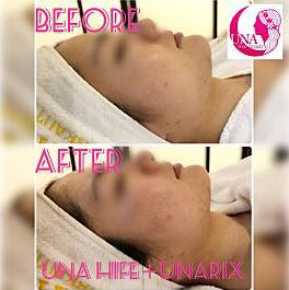 UNA ハイフ Before After