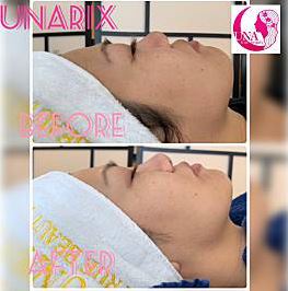 UNA ハイフ Before After