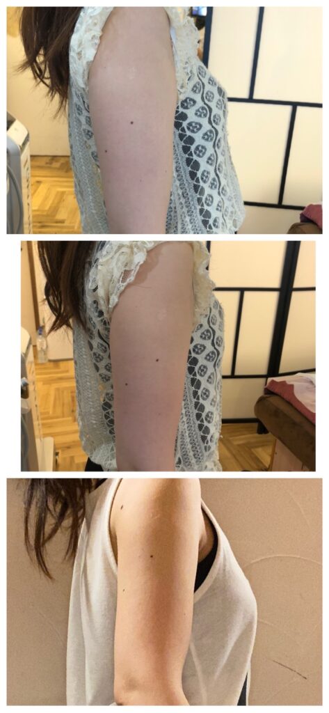 エムスレンダー二の腕