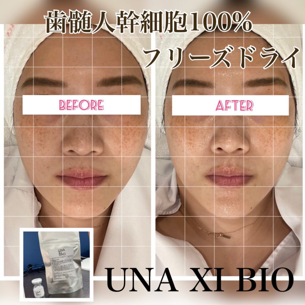 人幹細胞100%フェイシャルのビフォーアフター