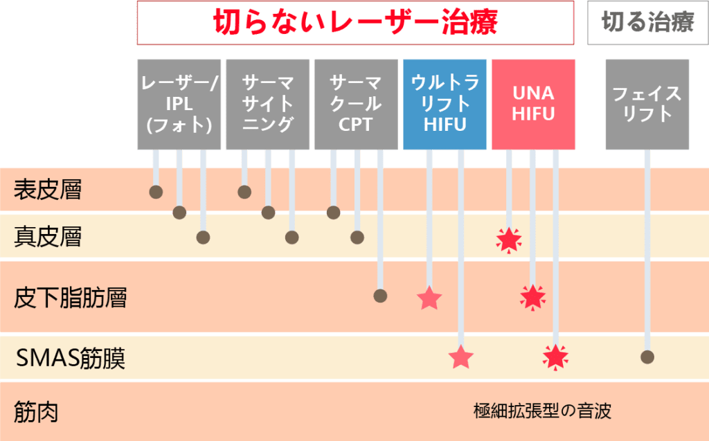 ウナハイフの切らないレーザー治療