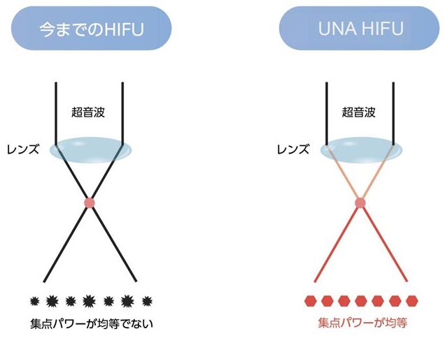 UNAハイフの焦点パワー