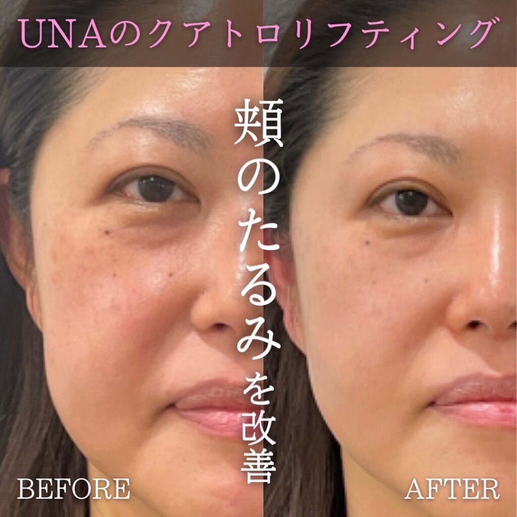 UNAのクアトロリフティングビフォーアフター
