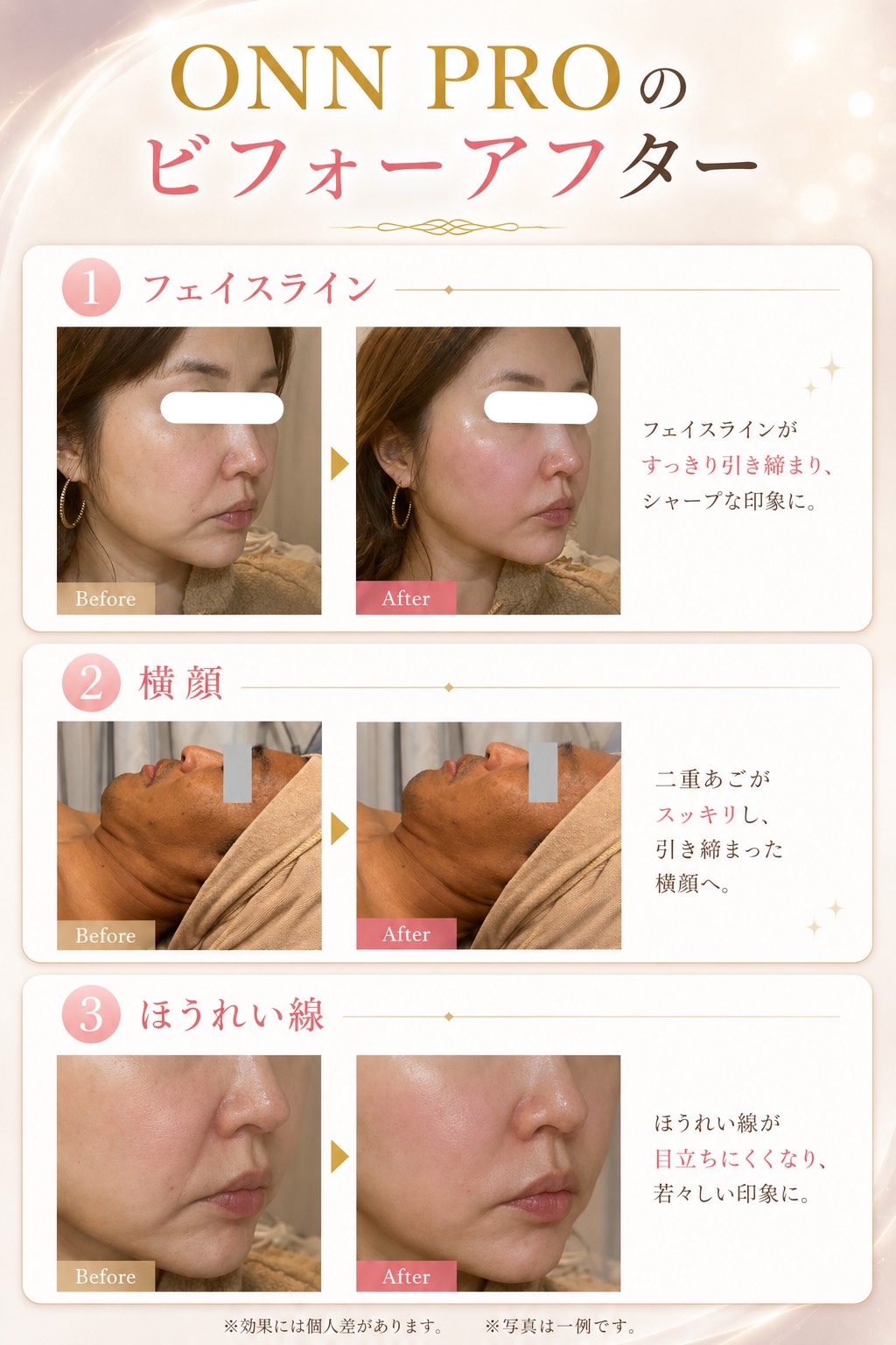 ONN PRO 施術のビフォーアフター（フェイスライン・横顔・ほうれい線）