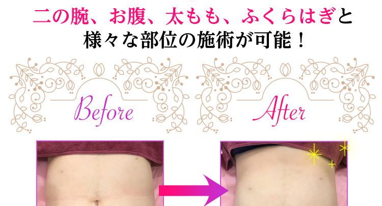 お腹が1回の施術でこの結果！