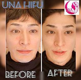UNA ハイフ Before After