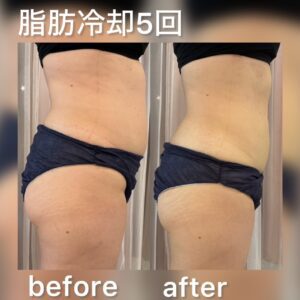 脂肪冷却5回のビフォーアフター
