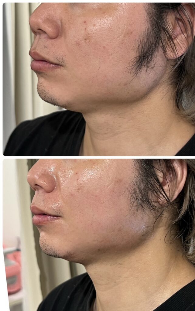 オンダプロフェッショナルビフォーアフター