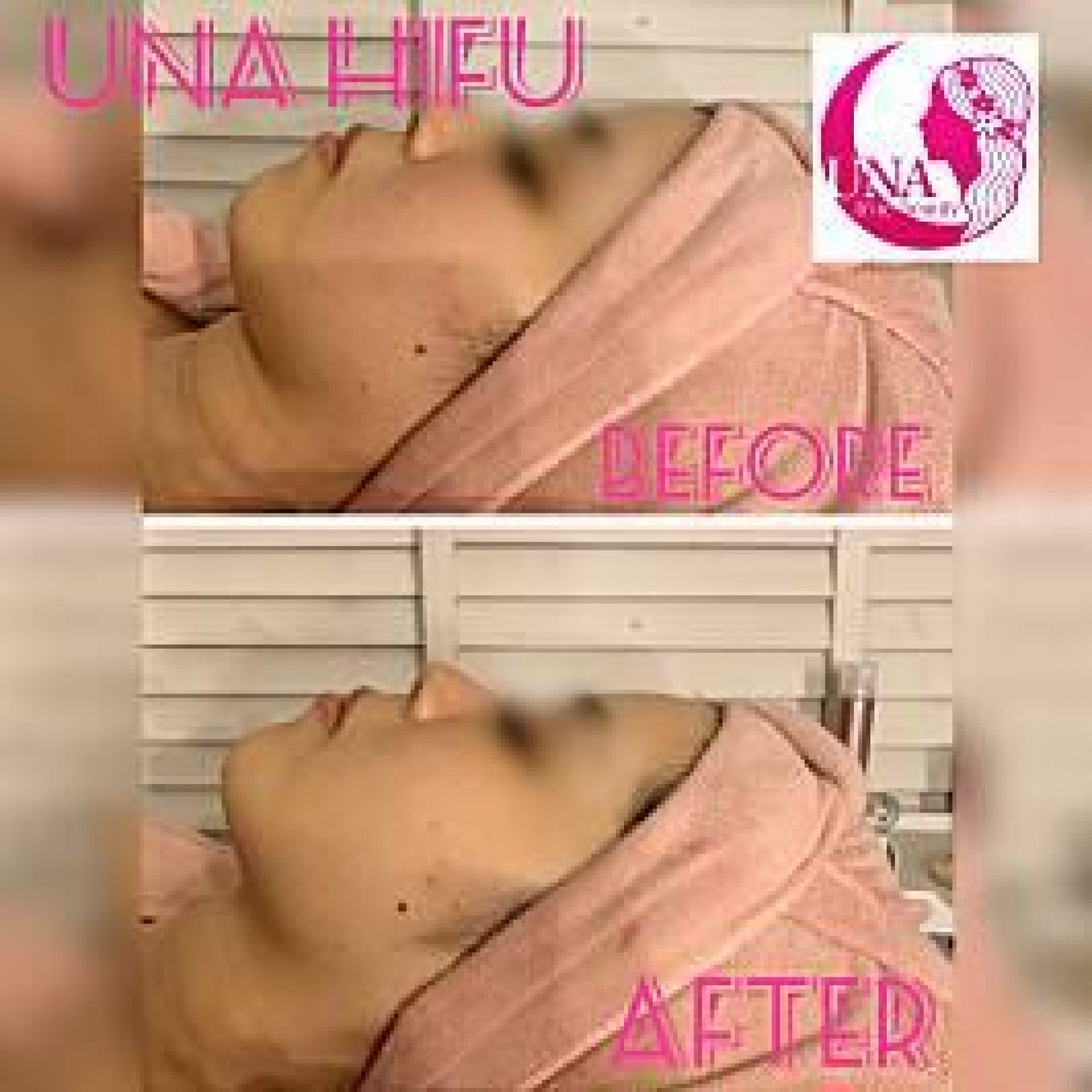 UNA ハイフ Before After